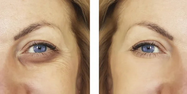 Γυναίκα Μάτι Πρησμένο Πριν Και Μετά Από Διαδικασίες Θεραπευτρια — Φωτογραφία Αρχείου