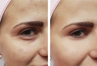 güzel kız yüz kırışıklıklar öncesi ve sonrası yordamları