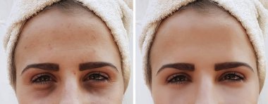 güzel kız kırışıklıklar yüzünde öncesi ve sonrası yordamları, sivilce