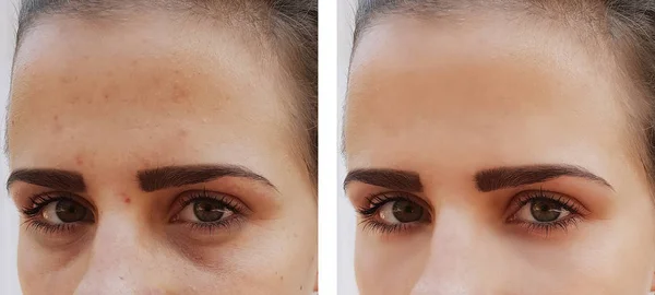 Schöne Mädchenfalten Gesicht Vor Und Nach Eingriffen — Stockfoto
