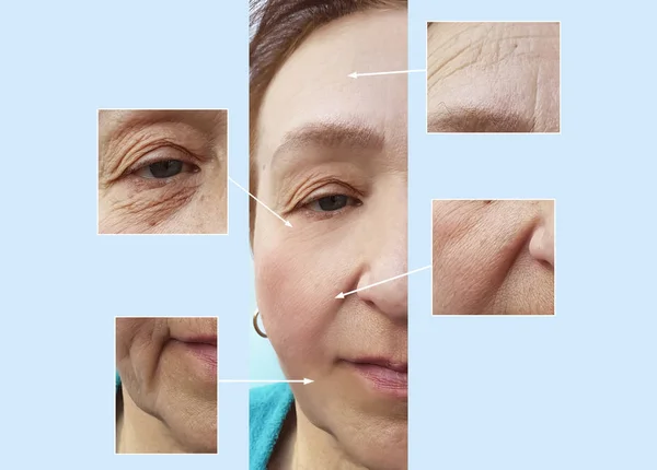 elderly woman wrinkles face before and after procedures