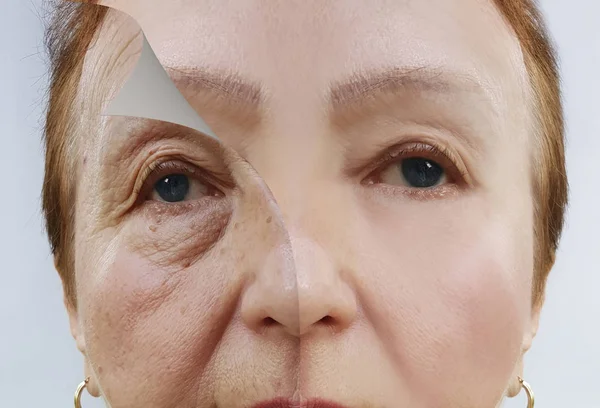 Falten Gesicht Älterer Frauen Vor Und Nach Eingriffen — Stockfoto