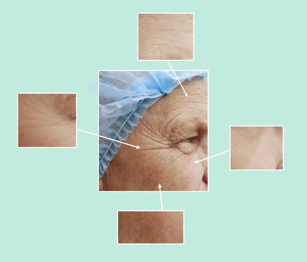 Manusia Menghadapi Keriput Sebelum Dan Setelah Prosedur Kosmetik Kolase — Stok Foto