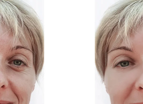 Woman Wrinkles Face Procedures Collage — Stock Photo, Image