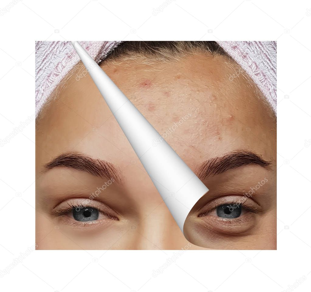  girl pimples, bags under the eyes before and after procedures, collage