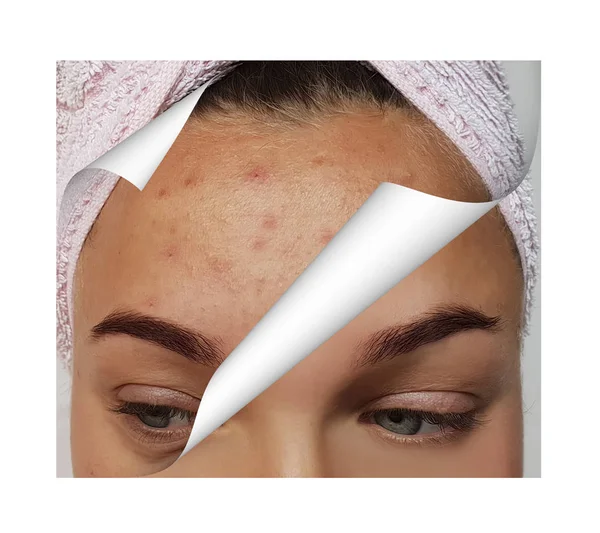 girl pimples on forehead, before and after procedures collage