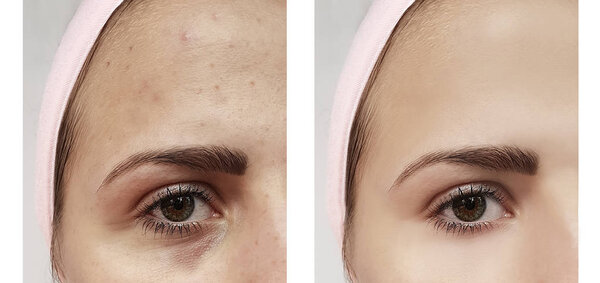 beautiful young girl acne, bruises under the eyes before and after procedures