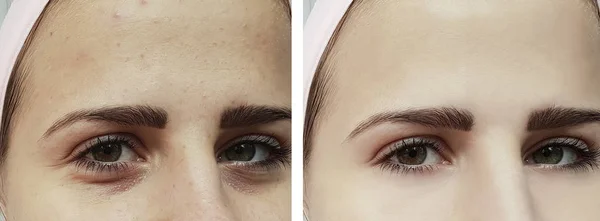 Beautiful Young Girl Acne Bruises Eyes Procedures — Stock Photo, Image