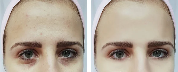 Bela Jovem Acne Hematomas Sob Olhos Antes Depois Procedimentos — Fotografia de Stock