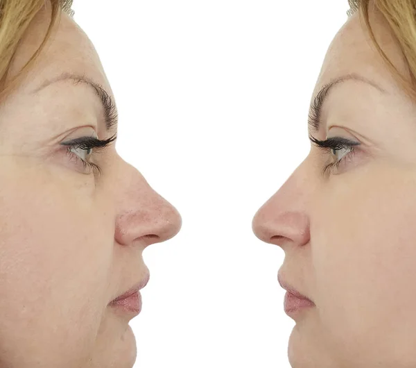 Wanita Hidung Punuk Koreksi Sebelum Dan Setelah Prosedur — Stok Foto
