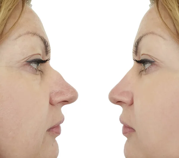 Female Nose Hump Correction Procedures — Stock Photo, Image