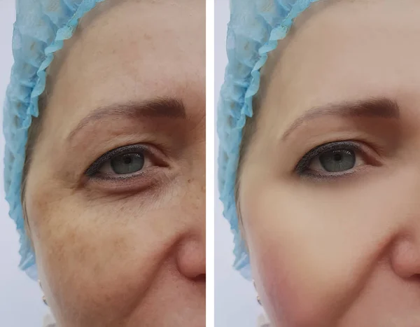 Kadın Kırışıklıkları Pigmentasyon Yüz Öncesi Sonrası Yordamları — Stok fotoğraf