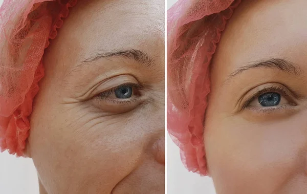 Arrugas Oculares Femeninas Antes Después Los Tratamientos — Foto de Stock