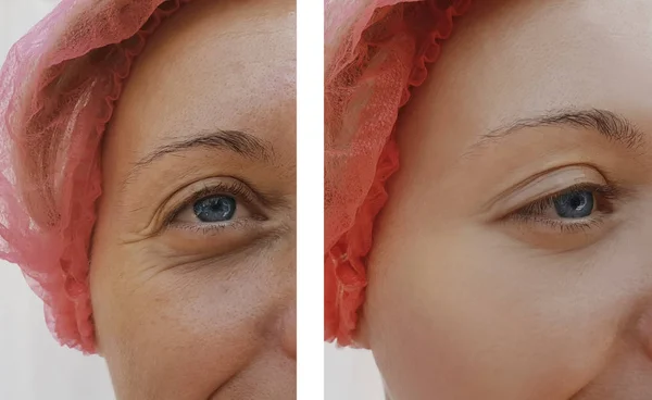治疗前后女性眼部皱纹 — 图库照片