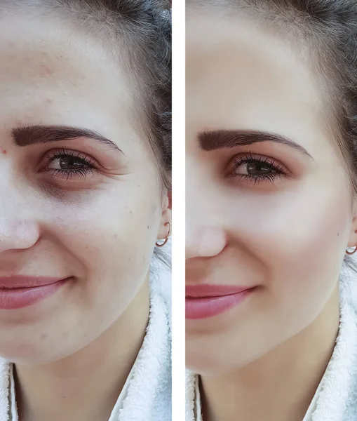 Schöne Mädchenfalten Akne Gesicht Vor Und Nach Eingriffen — Stockfoto