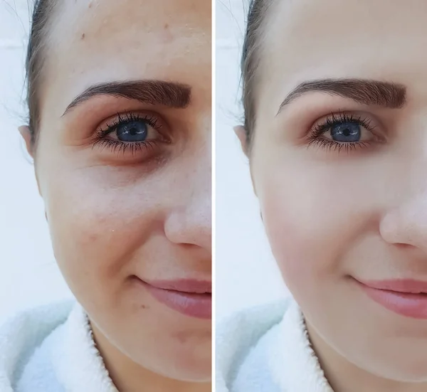 Gadis Cantik Wajah Keriput Jerawat Sebelum Dan Setelah Prosedur — Stok Foto
