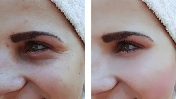 Güzel Kız Akne Prosedürleri Önce Yüzündeki Kırışıklıklar — Stok fotoğraf