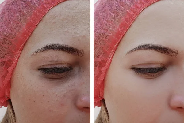 Güzel Kız Akne Prosedürleri Önce Yüzündeki Kırışıklıklar — Stok fotoğraf