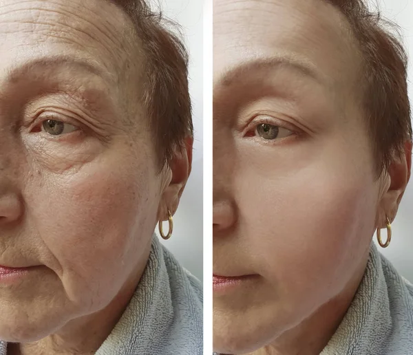 脸上的老太太的皱纹前后的程序 — 图库照片