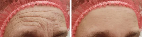 Rosto Uma Mulher Velha Rugas Antes Depois Procedimentos — Fotografia de Stock