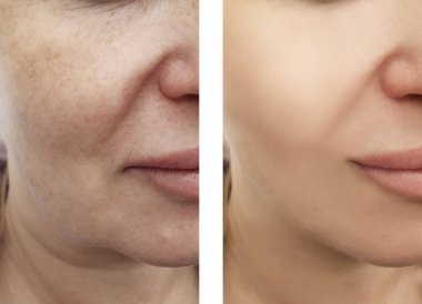 kadın kırışıklıkları öncesi ve sonrası yordamları