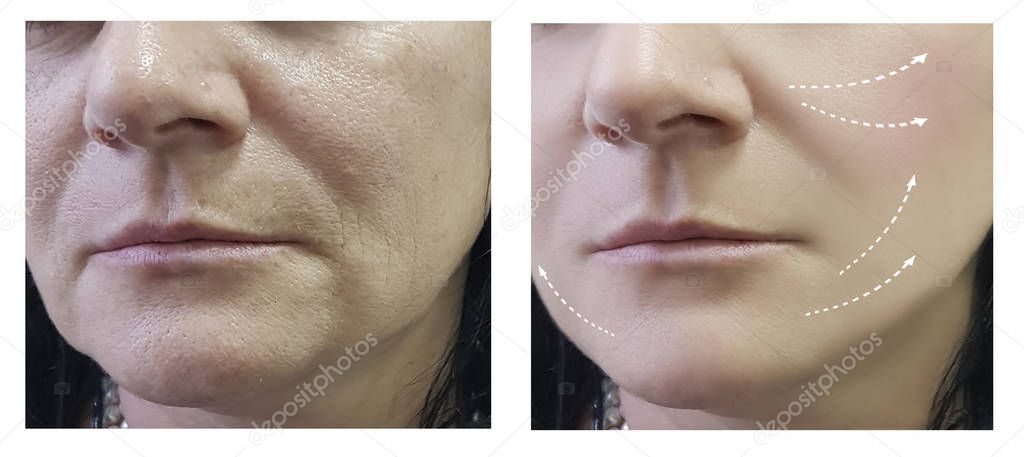 woman wrinkles before and after procedures