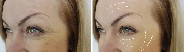 妇女皱纹之前和之后的程序 — 图库照片