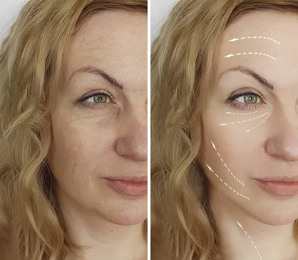 Arrugas Mujer Antes Después Procedimientos Faciales —  Fotos de Stock