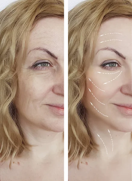 woman wrinkles before and after procedures, facial