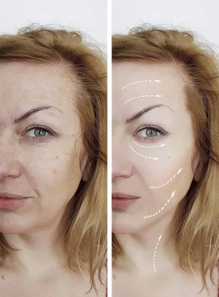 Kvinna Rynkor Före Och Efter Förfaranden Facial — Stockfoto