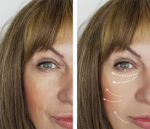 Woman Wrinkles Procedures Facial — Stock Photo, Image
