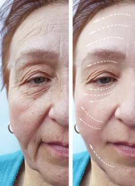 Yaşlı kadın kırışıklıkları öncesi ve sonrası yordamları, yüz