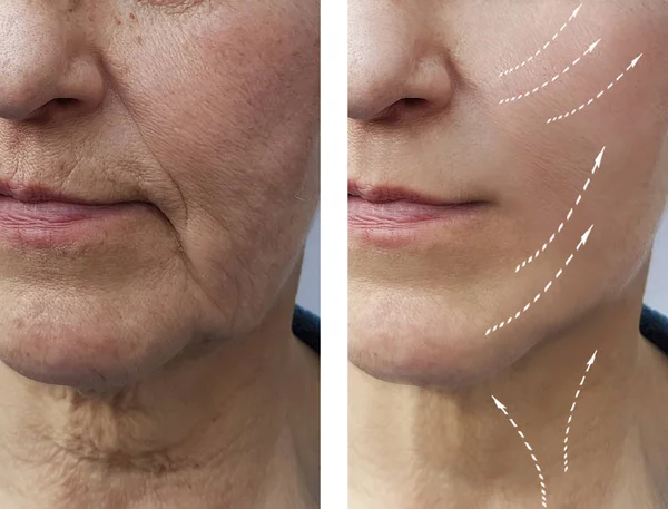 old woman wrinkles before and after procedures, facial