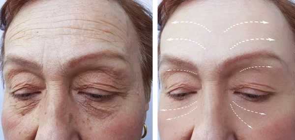 Rugas Mulher Velha Antes Depois Procedimentos Facial — Fotografia de Stock