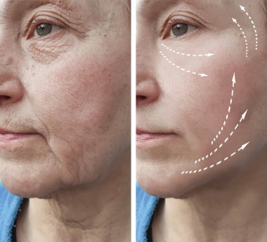Yaşlı kadın kırışıklıkları öncesi ve sonrası yordamları, yüz