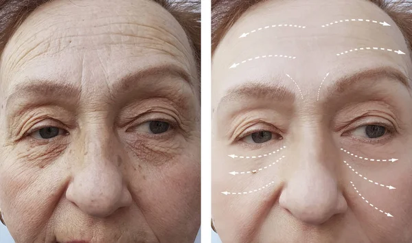 Anciana Arrugas Antes Después Los Procedimientos Faciales — Foto de Stock