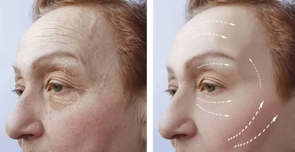 Anciana Arrugas Antes Después Los Procedimientos Faciales — Foto de Stock