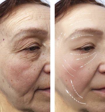 Yaşlı kadın kırışıklıkları öncesi ve sonrası yordamları, yüz