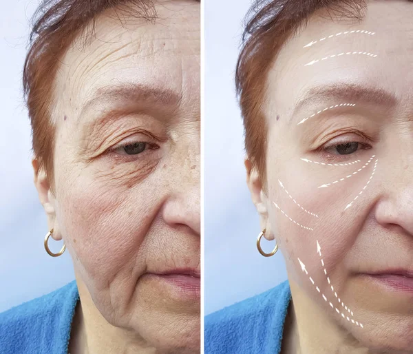 Old Woman Wrinkles Procedures Facial — Stock Photo, Image