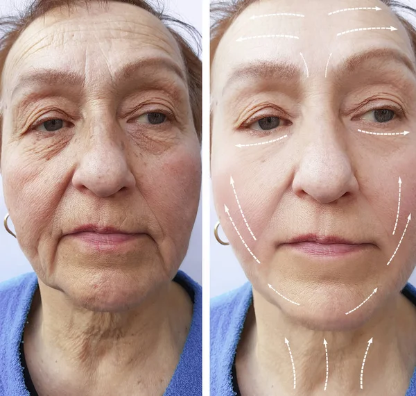 Old Woman Wrinkles Procedure — Stock Photo, Image