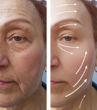 Yaşlı kadın kırışıklıkları önce ve sonra yordamı