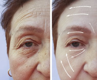 Yaşlı kadın kırışıklıkları önce ve sonra yordamı