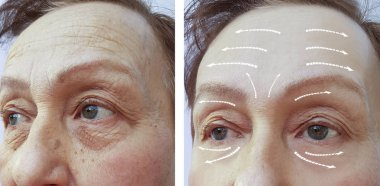 Yaşlı kadın kırışıklıkları önce ve sonra yordamı