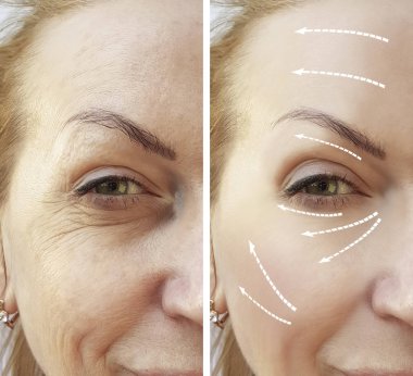 kadın kırışıklıkları önce ve sonra yordamı