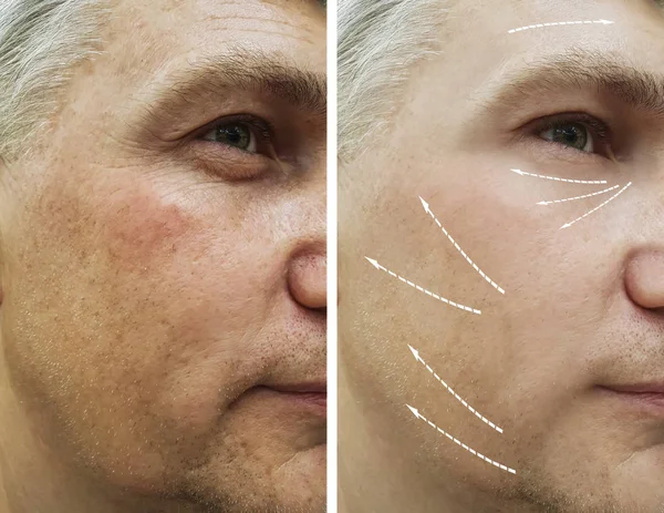 Man Keriput Wajah Sebelum Dan Setelah Prosedur — Stok Foto