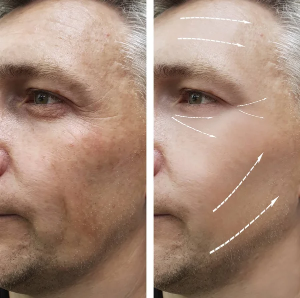 Man Keriput Wajah Sebelum Dan Setelah Prosedur — Stok Foto