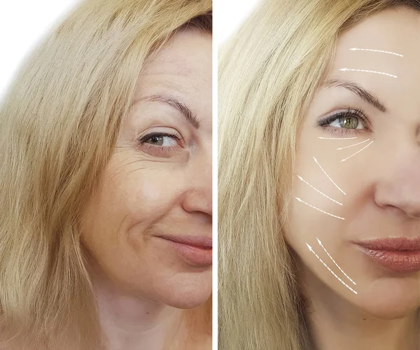 Arrugas Mujer Cara Antes Después Los Procedimientos — Foto de Stock
