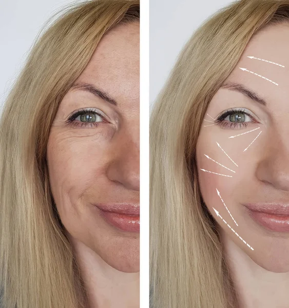 Frauenfalten Gesicht Vor Und Nach Eingriffen — Stockfoto