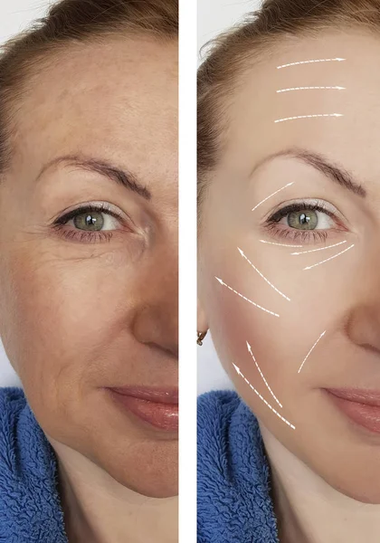 Woman Wrinkles Face Procedures — Stock Photo, Image