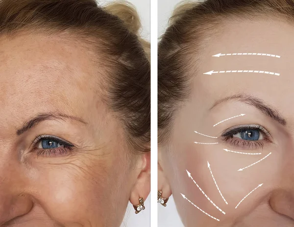 妇女皱纹面孔在规程之前和之后 — 图库照片